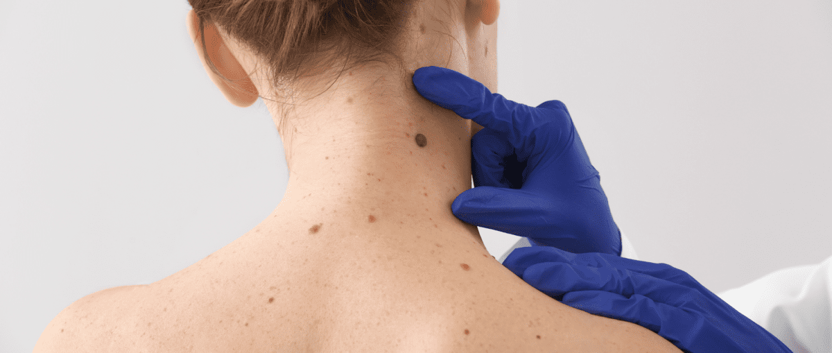 mole removal by a dermatologist